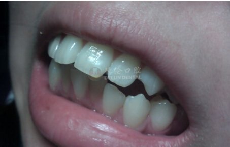 成人牙齿矫正有什么特点
