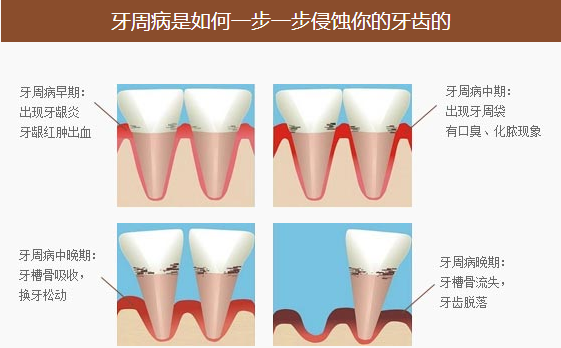 牙周病有什么危害