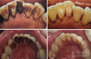 烟渍牙洗牙前后对比图