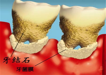 牙周病是怎么引起的